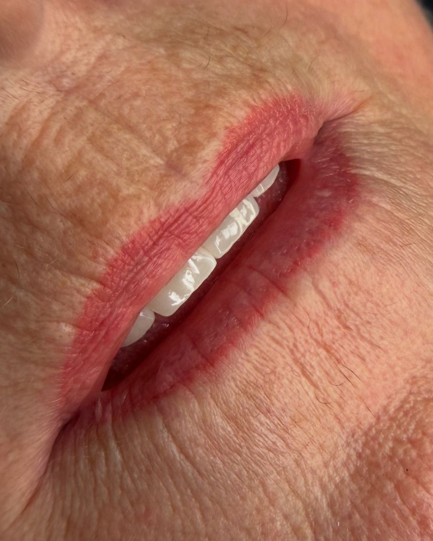 Lippigmentatie, lachende mond
